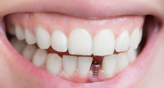 Talking Teeth: Why dental implants are better for your oral health