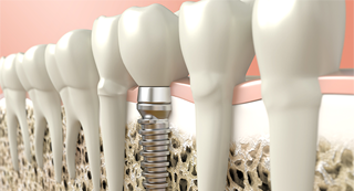 Dental Implants: What Can Go Wrong?