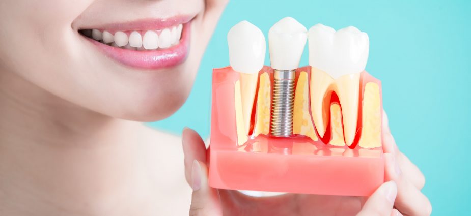 5 Tips to remember when adjusting to dental implants