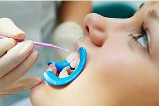 What are dental sealants and how can they benefit me?